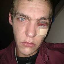 Defekt batteri: Det eksploderede lige op i hovedet på mig