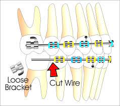 Or cut the wire, slide on a piece of heat shrink sleeving, then solder the two ends back together with. My Wire Came Loose And Is Poking What Do I Do Ask An Orthodontist Com