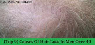 Both men and women develop this type of hair loss, which is the most common cause of hair loss worldwide. Top 9 Causes Of Hair Loss In Men Over 40 How To Get Great Hair