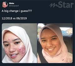 From ireach hd on vimeo. Muka Jerawat Teruk Bertahun Tahun Siap Bernanah Sehinggalah Suatu Hari Rakan Bapa Suruh Pantang Enam Bulan Saya Tak Sentuh Langsung Viral Mstar
