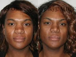 37 Year Old Black Female Requested Slight Elevation Of The Bridge Narrowing Of Nose Job Cosmetic Surgery Plastic Surgery