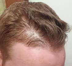 Explore hair loss treatments for male pattern baldness (androgenetic alopecia), a condition 2/3 of men will finasteride was effective at stopping hair loss in 83% of men compared to 28% of men in the. 1 Year On Fina Do I Have Any Hope Hairlosstalk Forums