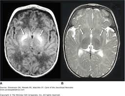 Image result for Kernicterus