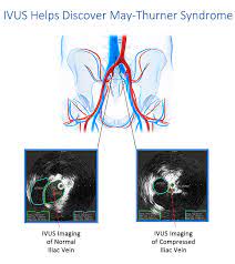 May Thurner Syndrome Is Iliac Vein Compression