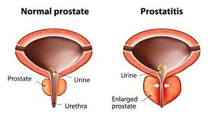 Was Ist Prostatitis Behandlung Von Chronischer Prostatitis