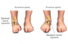 Jects were tested in a semirecumbent position sense in the ankle at angles near maximal inversion. Ankle Sprains Kingsland Physio And Massage