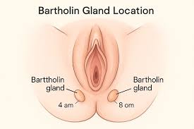 Image result for Bartholin's gland abscess