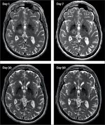 Image result for Thalamotomy
