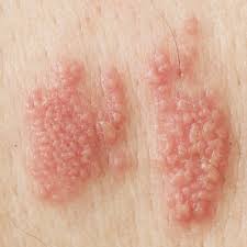 The blisters heal without scarring but they have a tendency to return. Symptoms Of Genital Herpes Superdrug Online Doctor