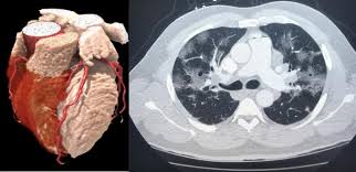 After reading your post, i would not think it is sarcoidosis. Impact Of Cardiac Ct During Covid 19 Daic