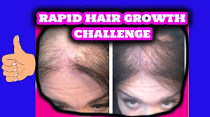 For hair growth, take two eggs and mix it with one cup yogurt and one tablespoon honey and lemon juice. Can Egg Yolks Cure Hair Loss Parsa Mohebi Hair Restoration