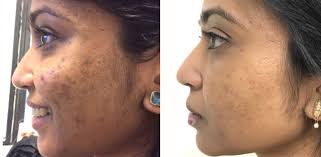 When is the new york city marathon? Microneedling Before And After Pictures Russak Aesthetic Centre New York City Ny