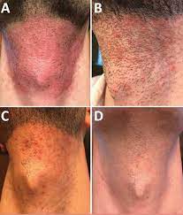 When your hair follicles are infected, they will likely be itchy, swollen, and painful. Irritated Hair Follicles Causes Symptoms Diagnosis Treatment
