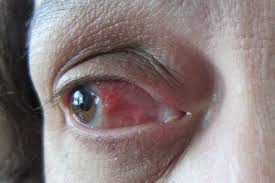 You should be fully aware about the effects before surgery. My New Reality After Retinal Surgery Joyceholmes