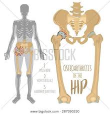 The inguinofemoral region is a relatively complex one that is significant for clinicians across various fields. Hip Osteoarthritis Vector Photo Free Trial Bigstock
