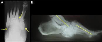 Scielo Brasil Charcot Neuroarthropathy Realignment Of Diabetic Foot By Means Of Osteosynthesis Using Intramedullary Screws Case Report Charcot Neuroarthropathy Realignment Of Diabetic Foot By Means Of Osteosynthesis Using Intramedullary