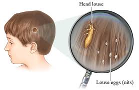 Image result for lice vs nits