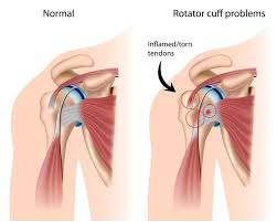 Shall i put my arm in a sling? Rotator Cuff Injury Guide Causes Symptoms And Treatment Options