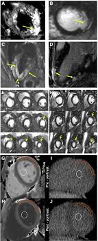 Manage these post covid cardiovascular. Recognizing Covid 19 Related Myocarditis The Possible Pathophysiology And Proposed Guideline For Diagnosis And Management Sciencedirect