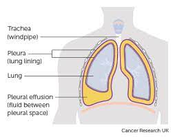 Treatment For Fluid On The Lung (Pleural Effusion) | Coping Physically |  Cancer Research Uk