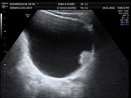 Urinary Bladder Carcinoma Looking Through A Transducer