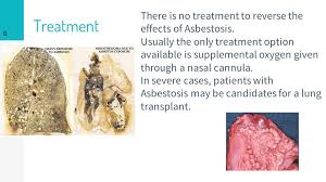 Lung cancer is a serious illness which none of us wish to face. Asbestosis Ppt Video Online Download