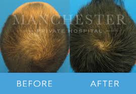 A doctor removes a strip of donor skin and grafts it to the bald site, earning fut the moniker of strip surgery. Hair Transplant Manchester Hair Restoration Hair Loss The Manchester Private Hospital