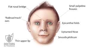 This is often associated with a broad flat nasal bridge. Pin On Fasd