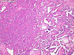 Patients have a median survival of approximately 1 year from the time of diagnosis (1). Webpathology Com A Collection Of Surgical Pathology Images
