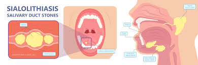 Image result for Sialoadenitis