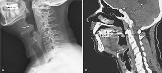Image result for Epiglottitis