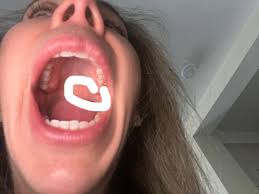 Image result for Erythroplakia roof of mouth