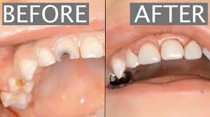 Kids Crown And Root Canal Cosmodent India