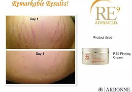 Bio Oil Before After Stretch Marks Firm And Watch Stretch Marks Disappear Results Driven Ultra Premium Products Arbonne Bodyfirming An Body Firming Cream Arbonne Cosmetics Arbonne Skin Care