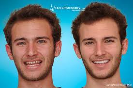 Which Type Of Veneer Is Best