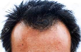 Normal hair thinning (resulting from follicular miniaturization) involving the temples, frontal hairline, and crown of the scalp, known as it works best for balding at the top and back of the head and less well for the front area of the scalp. Male Head With Hair Loss Hair Loss And Balding Front Stock Photo Picture And Royalty Free Image Image 47514260