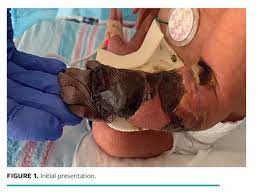 Necrosis definition, death of a circumscribed portion of animal or plant tissue. Challenging Cases Neonatal Skin And Soft Tissue Necrosis Leading To Amputation Wound Management Prevention
