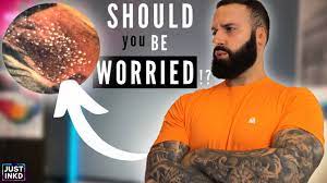 Getting rid of the small, red bumps that appear after waxing can be quick and painless. Dealing With Pimples Irritation Rashes Infection On A New Tattoo Youtube