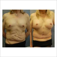 Top surgery, or male chest reconstruction, involves the surgical removal of breast tissue and tailoring of the remaining chest skin, when needed, to generate a masculine chest contour. Mtf Top Surgery
