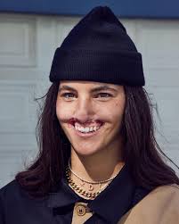 Exactly one year ago today my life changed completely. This attack has  taught me to truly love myself inside and out regardless of what people  have to say. It taught me that