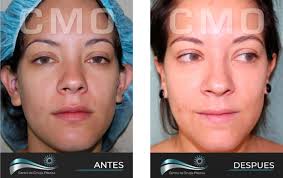 Otoplastia «Orejas»