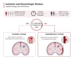 Image result for Stroke Pathophysiology