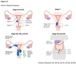 Learn uterine cancer symptoms, signs, prognosis, survival rate, stages, and treatment. Uterine Cancer For Aprns Nursing Ce Course Nursingce