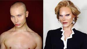 Unfortunately, accidents, age or genes can lead to a loss of full or partial vision, leaving us with a foggy or blurred vie. Alexis Stone Convinced Followers He Got Botched Plastic Surgery Allure