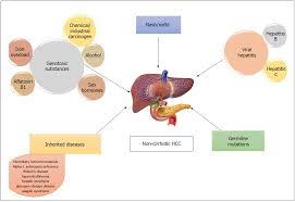 hepatocellular carcinoma in non cirrhotic liver a