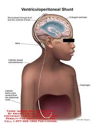 Amicus Illustration Of Amicus Medical Ventricles Brain Ventriculoperitoneal Shunt Catheter Drains Cerebral Fluid Abdominal Cavity Subcutaneous Valve Skull Enlarged Diaphragm
