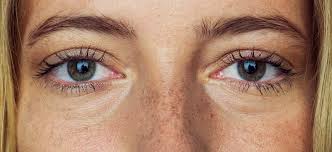 An Extreme Example Of Corneal Haze Seen At Around Six Months After... |  Download Scientific Diagram
