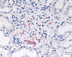 The degree of symptoms can range from mild to severe. Idiopathisches Systemisches Capillary Leak Syndrom Clarkson Syndrom Springerlink