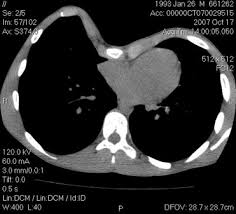 Learn these exercises that can help. Pectus Excavatum Historical Background Clinical Picture Preoperative Evaluation And Criteria For Operation Sciencedirect