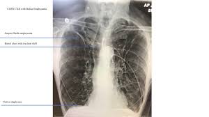 Image result for Emphysema
